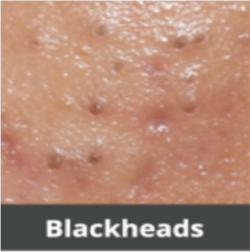 Bkackheads