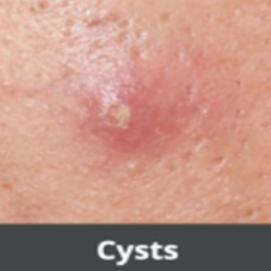 Cysts