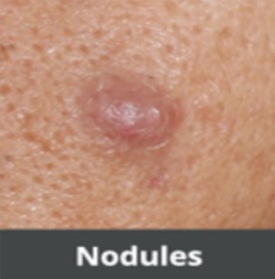 Nodules