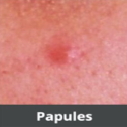 Papules