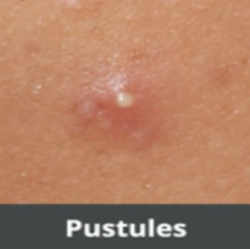 Pustules
