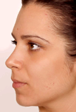Mild acne: Few acne spots, 1-5 small pimples