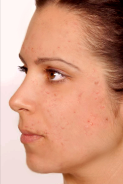 Mild to moderate acne: Some acne spots affecting less than half of the face with no cysts or nodules, 6 to 15 pimples