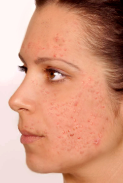 Moderate acne: Many acne spots affecting more than half of the face with some cysts and nodules, 16 to 30 pimples
