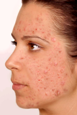 Severe: Extreme number of spots affecting most of the face with large cysts and nodules, more than 30 pimples with cysts.